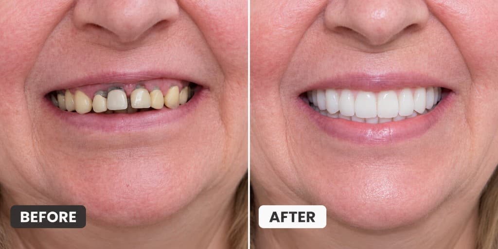 Before and after full mouth restoration: failing teeth removed and replaced with fixed implant-supported bridges